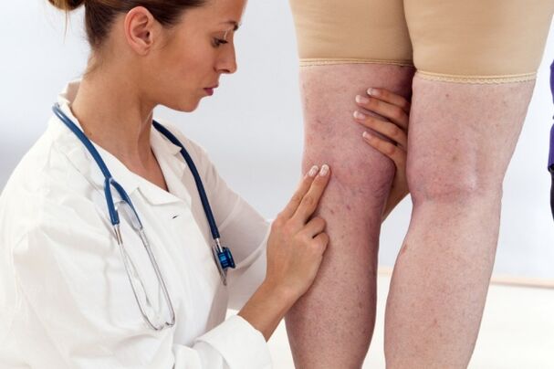 Treatment of varicos in women
