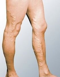 Varicose veins in a man's leg