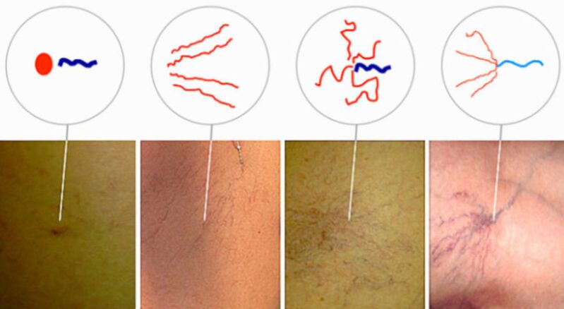 Spider veins in the initial stages of varicose veins