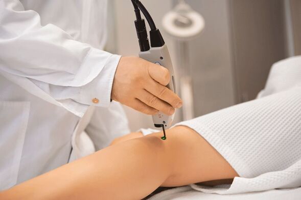 Laser coagulation of the veins of the lower limbs