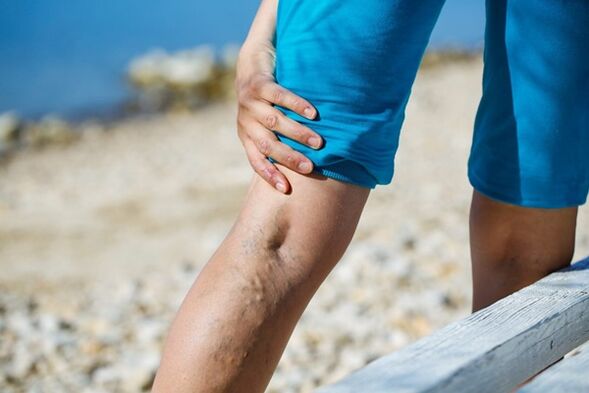 Throbbing pain in the legs with varicose veins
