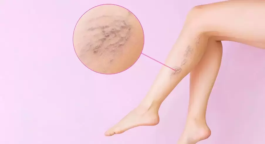 Twisted protruding veins on the legs with varicose veins