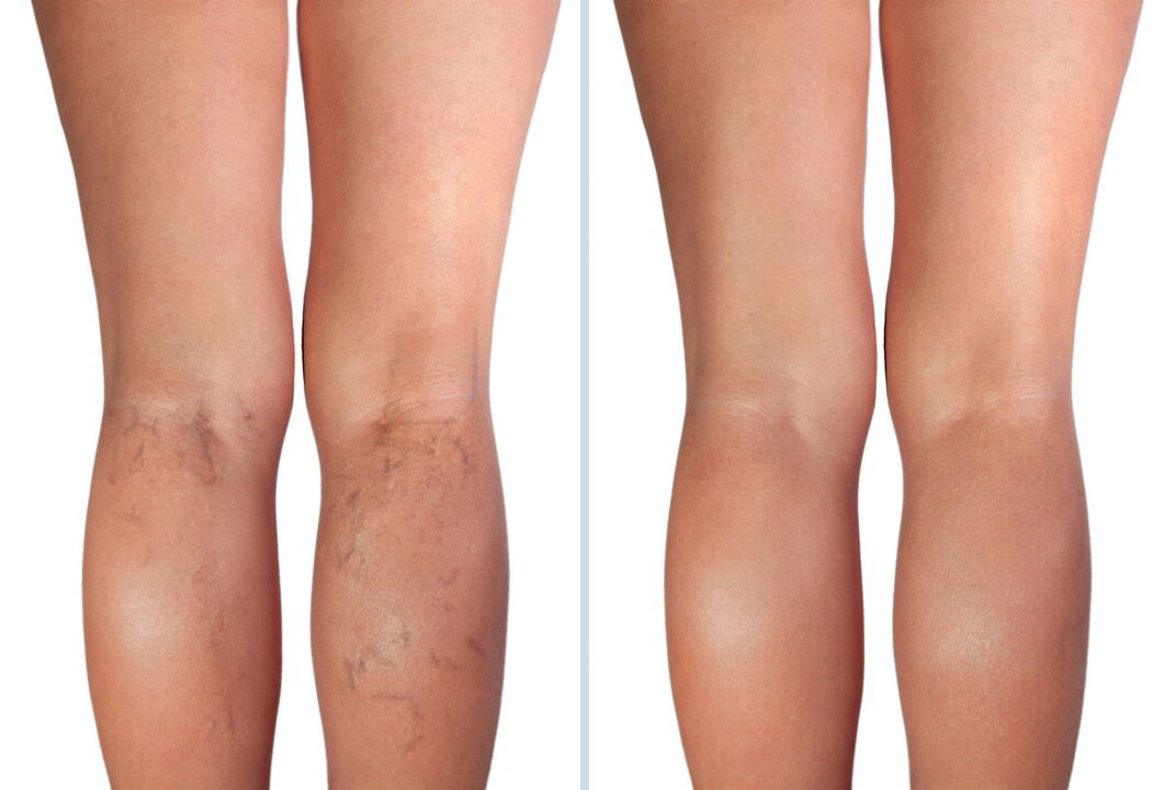 sections of varicose veins