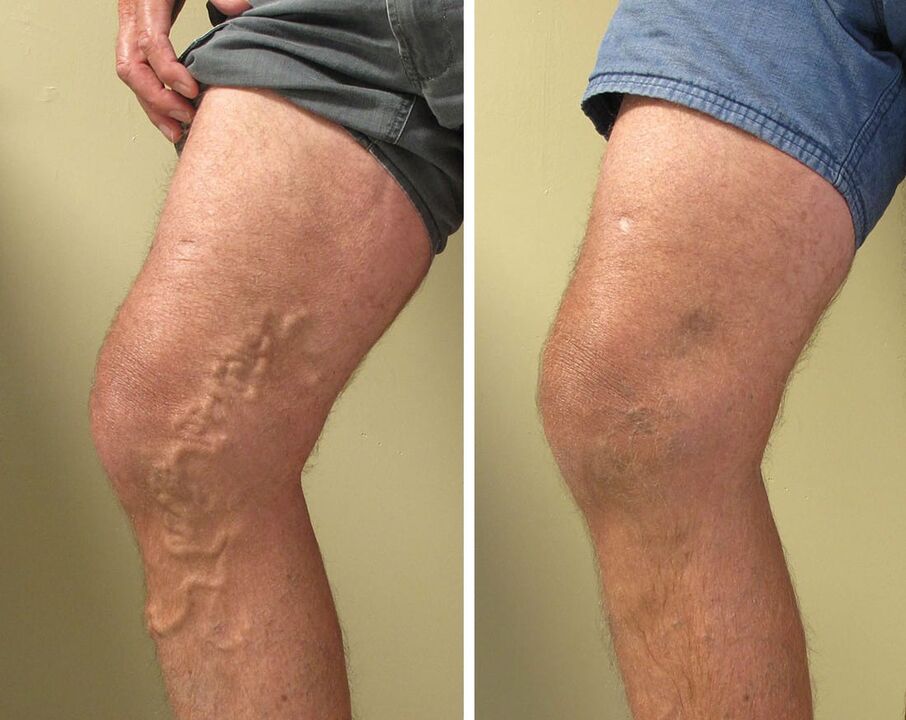 Varicose veins of superficial veins cannot be ignored