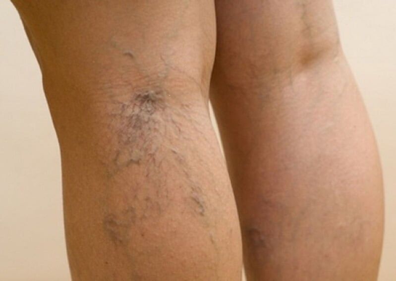 The beginning of the formation of varicose veins in the legs